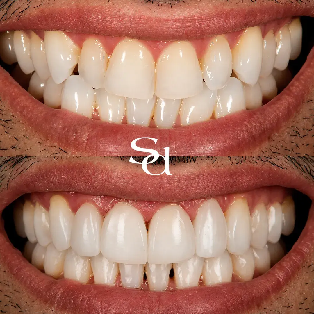 Clear aligners and bonding before and after