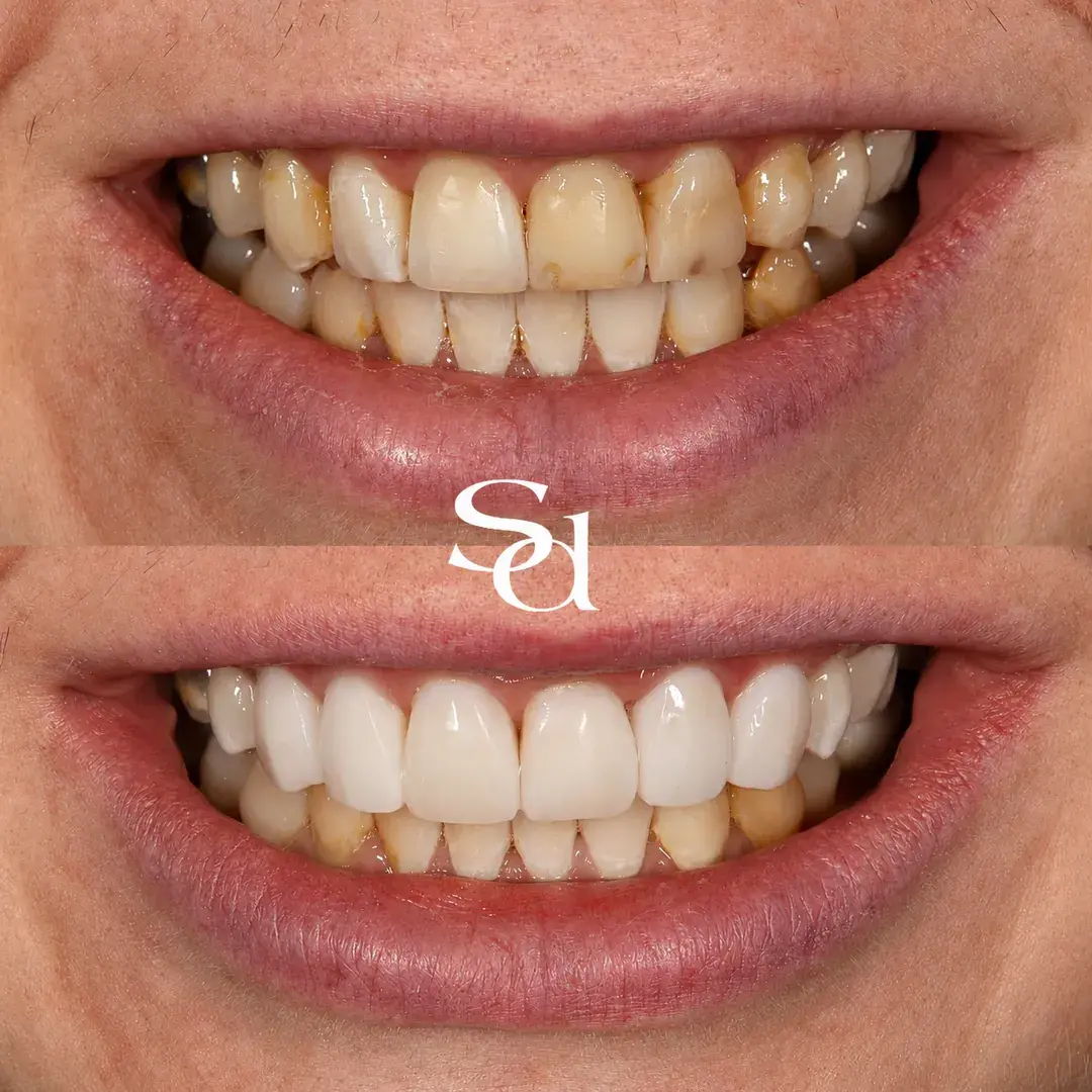 Porcelain veneers before and after