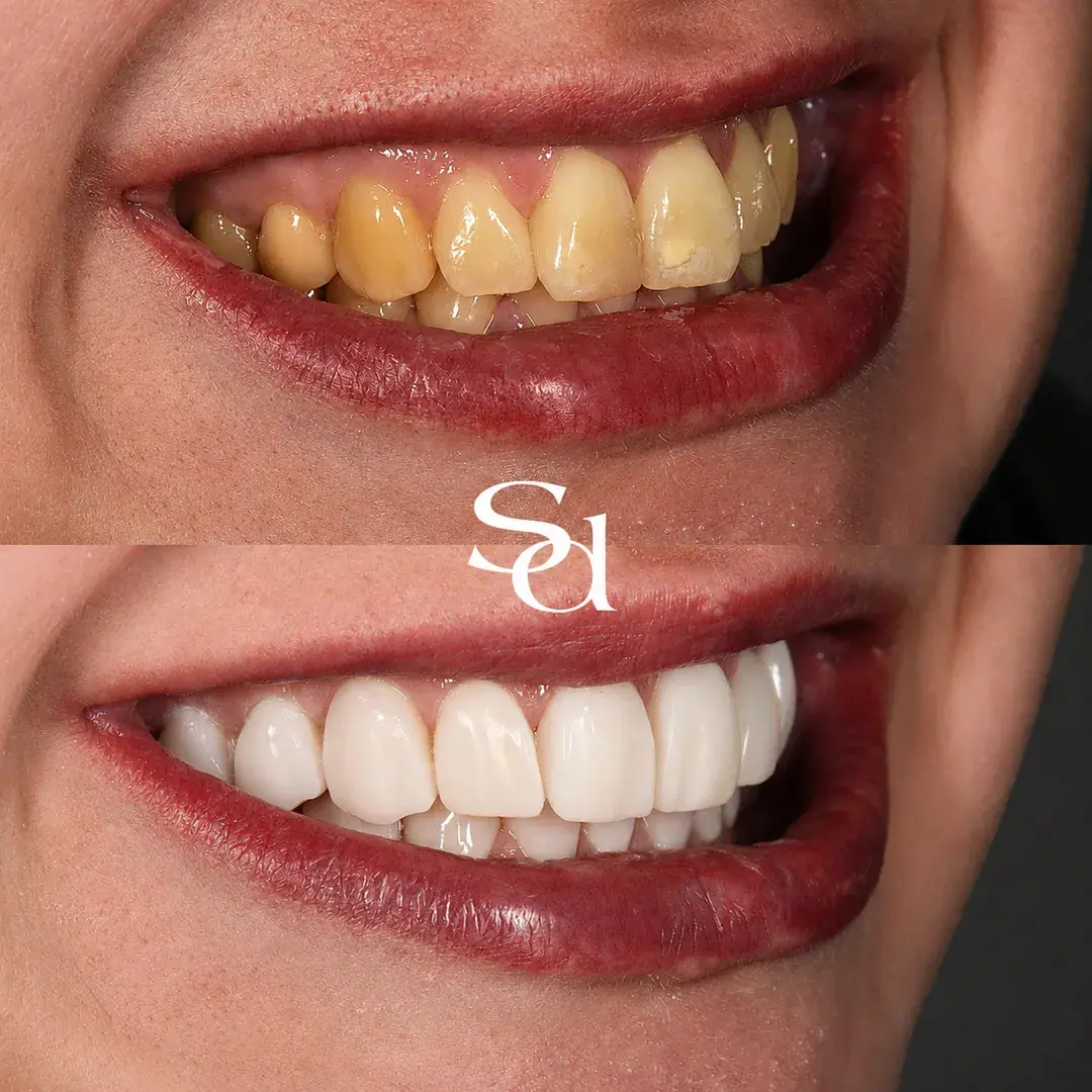 Veneers and whitening before and after