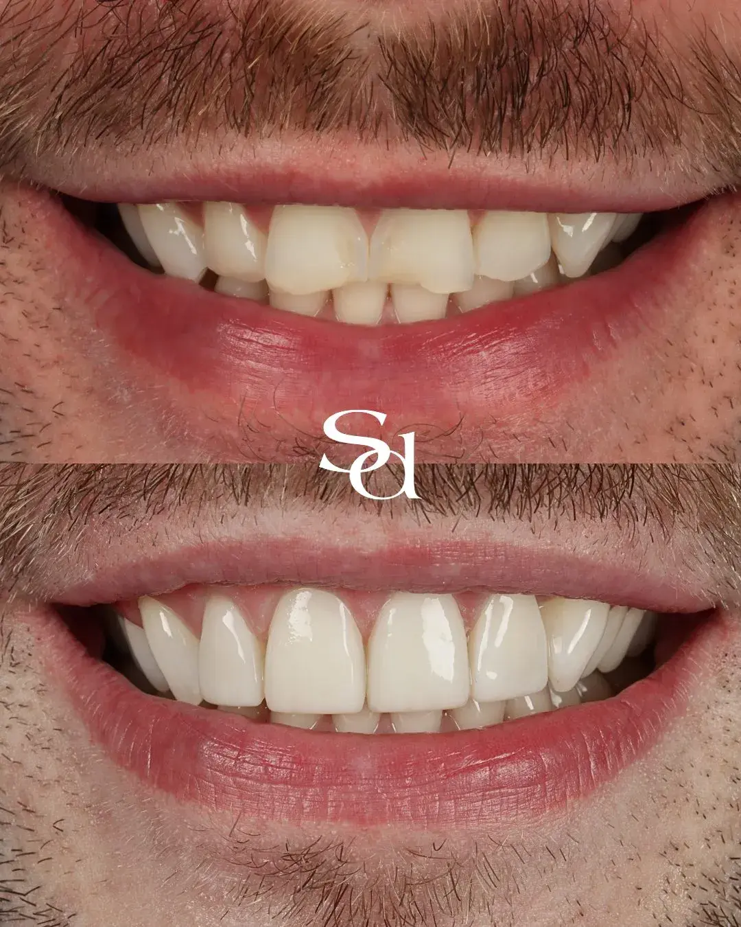 Before and after porcelain veneers at Sale Dental Spa